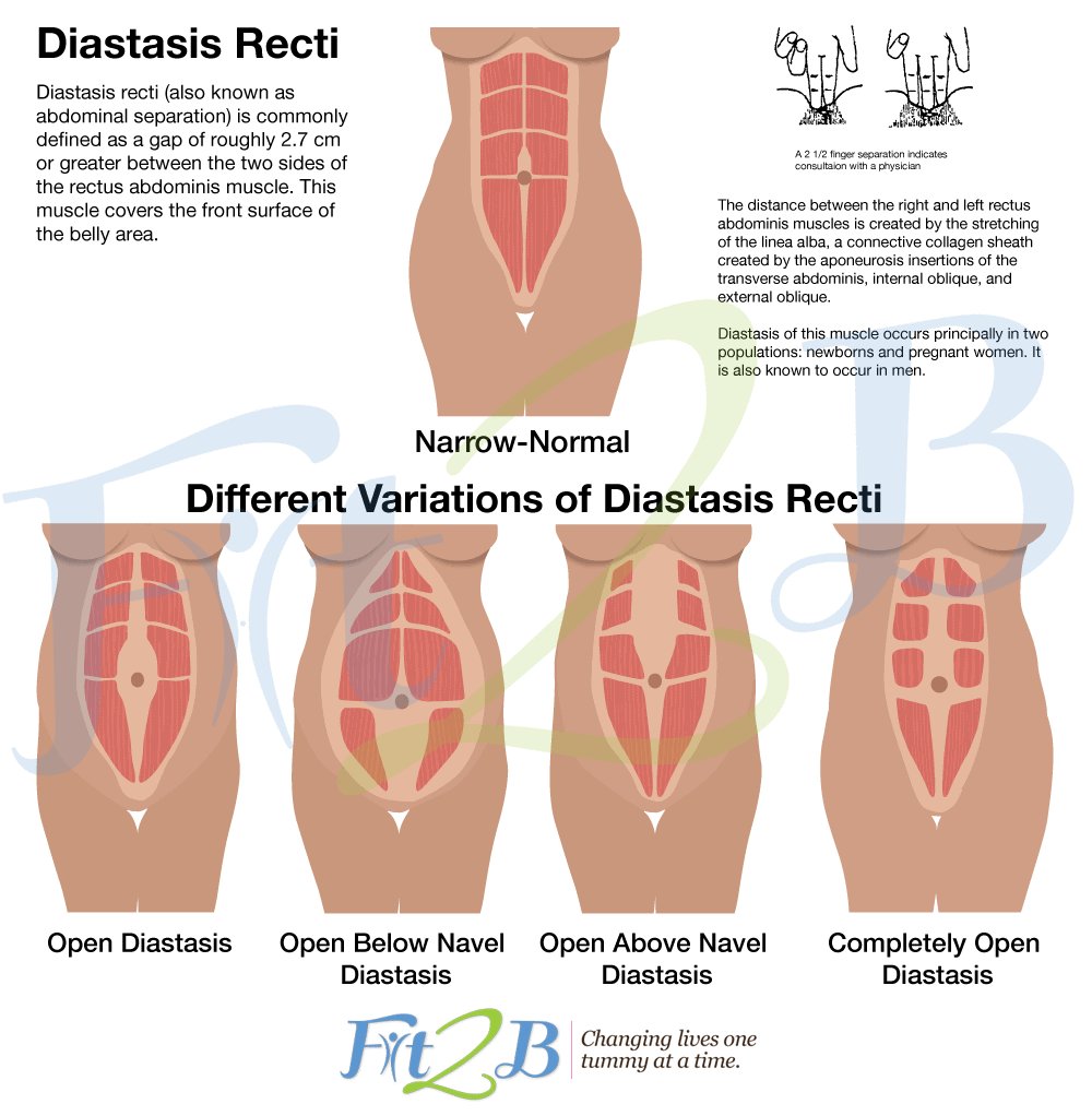 Diastasis recti exercise programs can help you heal all of these!